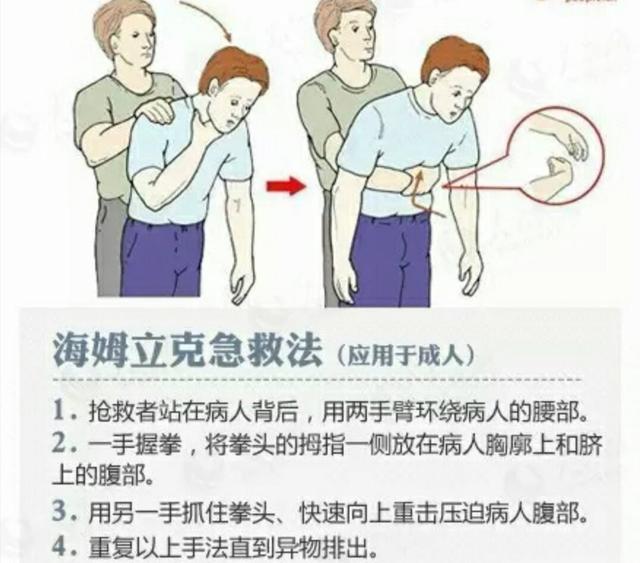 海姆立克急救法